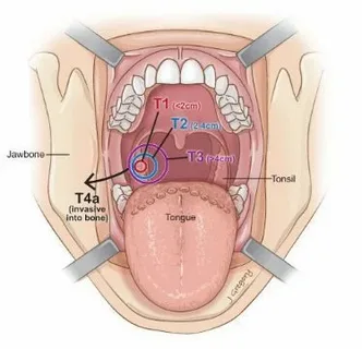 can tonsils grow back after being removed? - tymoff
